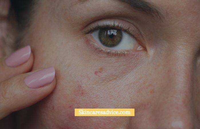 How to Get Rid of Redness on Face