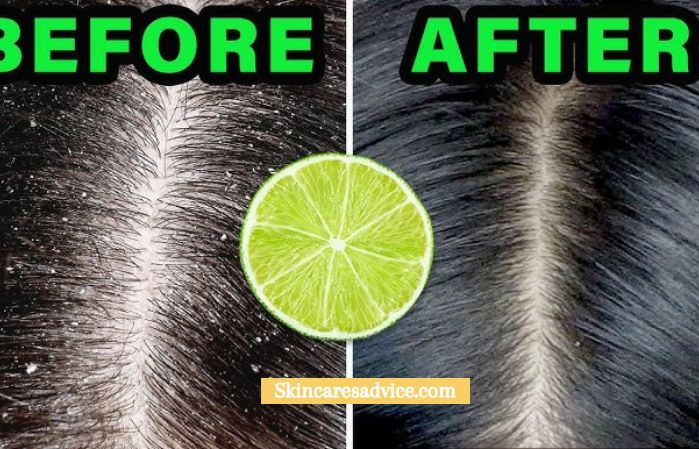 How to Remove Dandruff Permanently